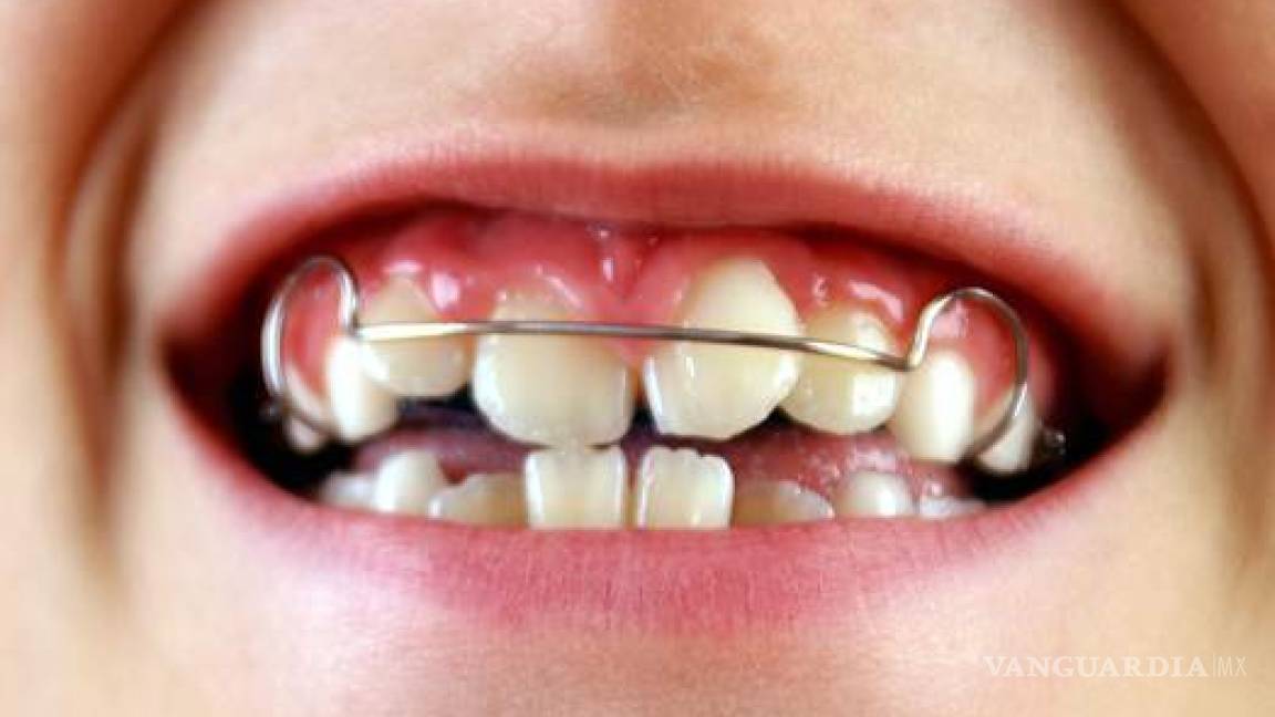 Dientes Chuecos Son Hereditarios Y Podrían Prevenirse