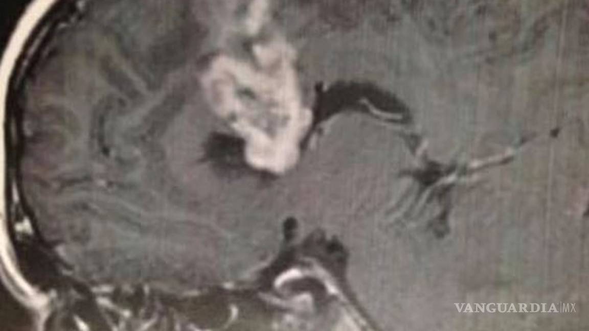 $!Un choque le salva la vida... descubren que tenía un tumor cerebral durante examen de rutina