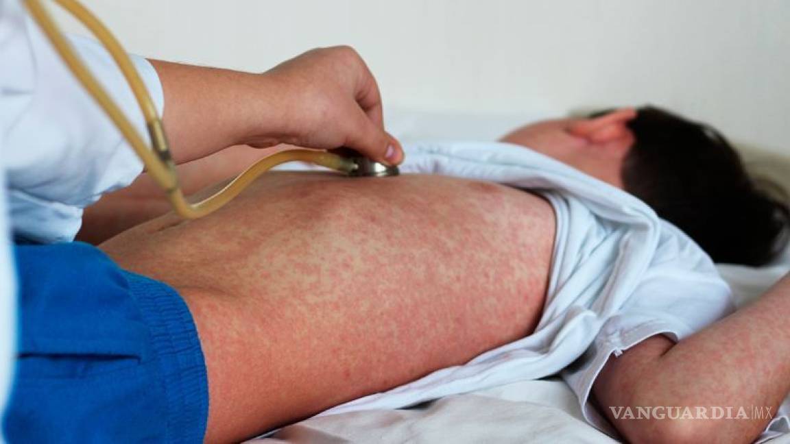Registran 87 casos de sarampión en el Valle de México