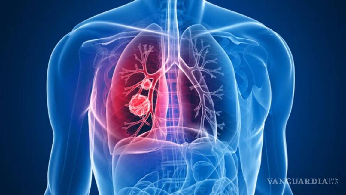 Dan a conocer el mapa más amplio del cáncer de pulmón, el proyecto británico TRACERx