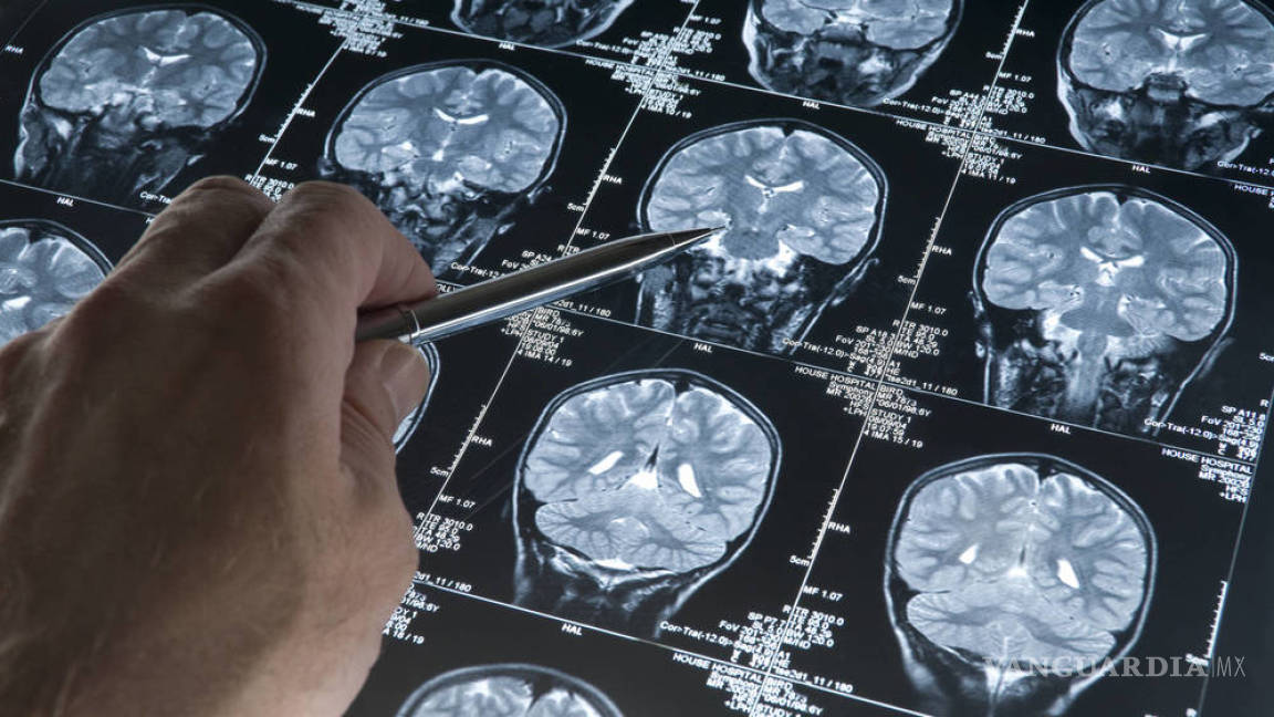 Alzheimer podría ser curado, científicos chilenos descubren cómo detener su progreso
