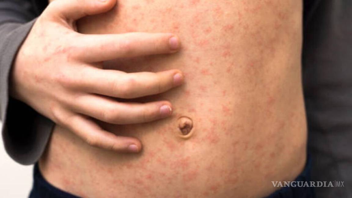 Estos son los síntomas de Sarampión en niños... señales de alerta que se deben atender para evitar complicaciones