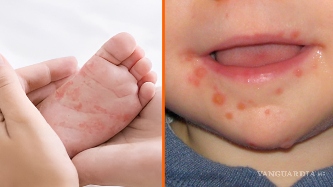 Surge brote de virus Coxsackie en Hidalgo, ¿Qué es, cuáles son los síntomas y cómo prevenir contagiarse de esta enfermedad que afecta principalmente a bebés y niños?