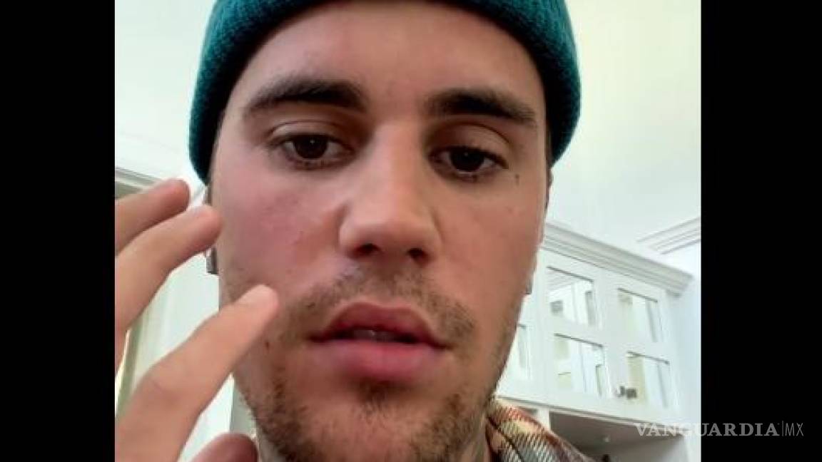 Justin Bieber tiene paralizada la mitad de su rostro por un herpes; pospone conciertos