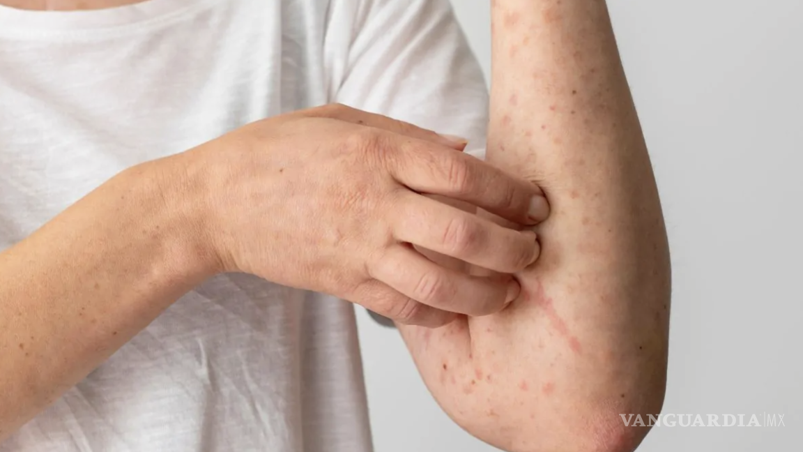 $!El Sistema Especial para la Vigilancia Epidemiológica ha confirmado 9 mil 074 casos.