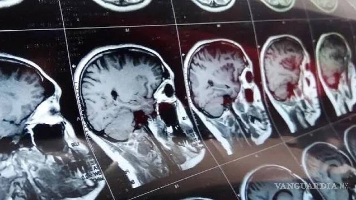 Niño se curó de cáncer cerebral, es el primer caso exitoso en el mundo