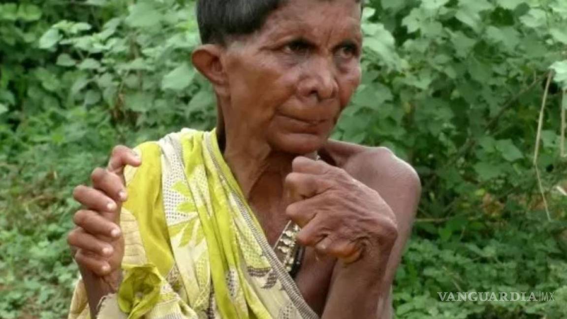 Mujer de la India nace con 20 dedos en los pies y 12 en las manos, la comparan con una bruja