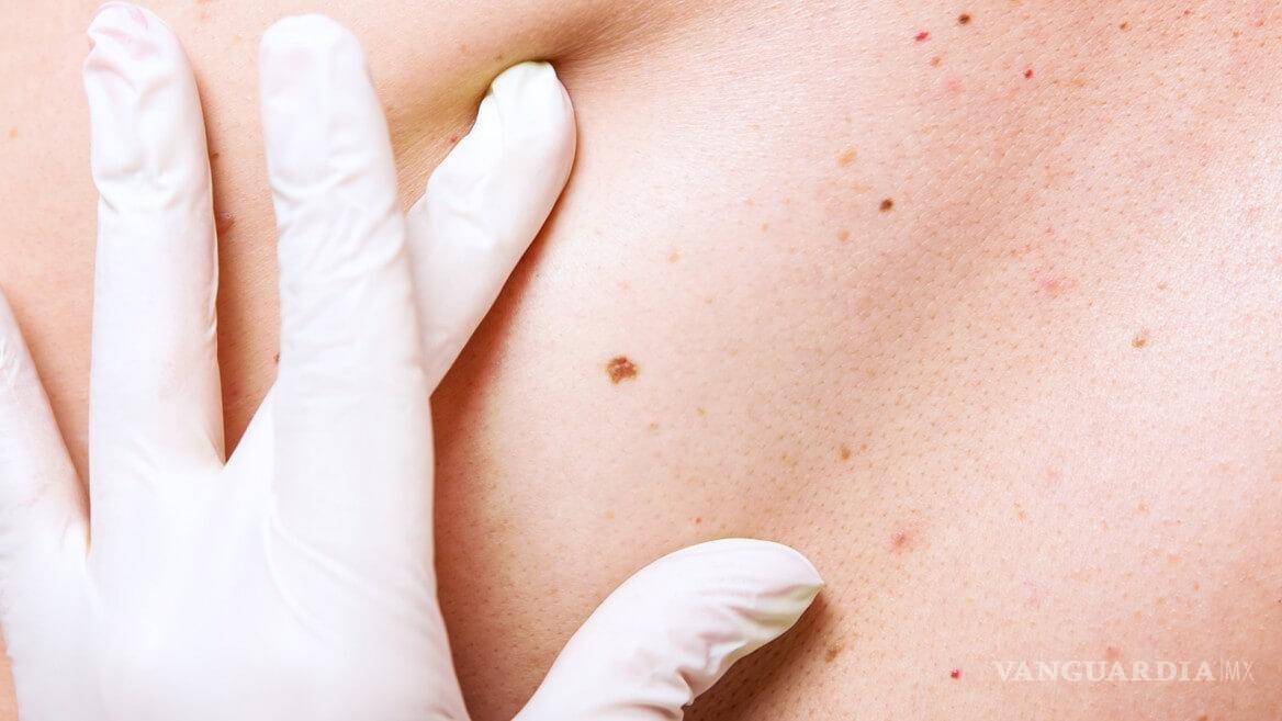 $!La forma más segura de eliminar un acrocordón es con la ayuda de un dermatólogo.