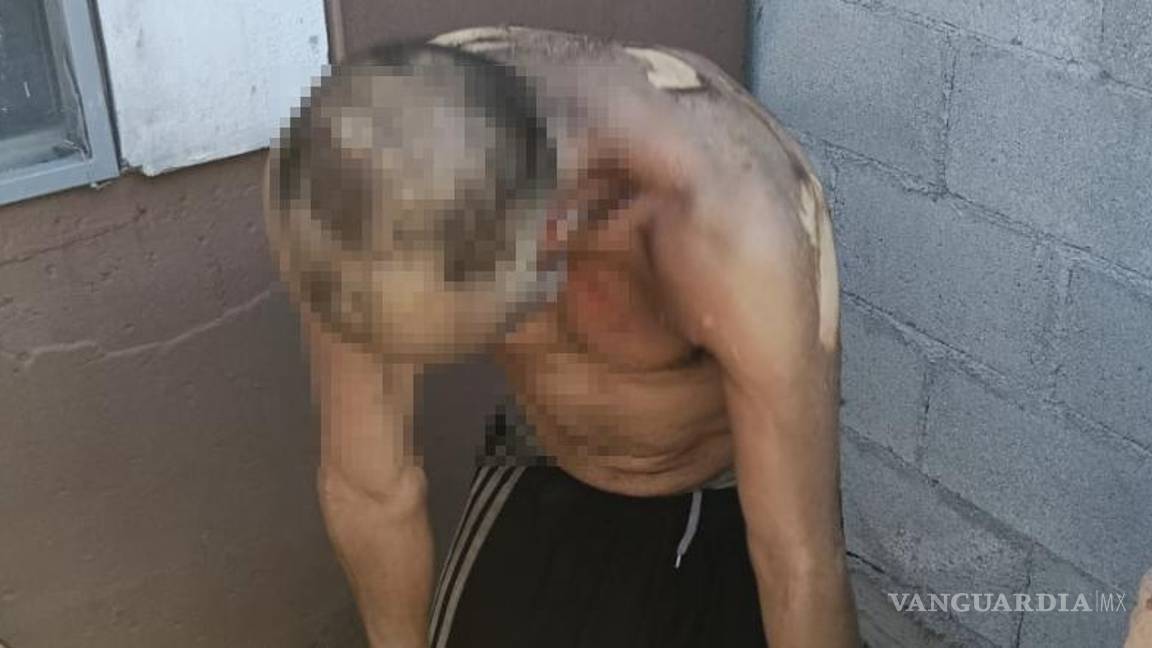 $!Ricardo fue internado con quemaduras graves tras el incendio ocurrido en Nuevo Mirasierra.