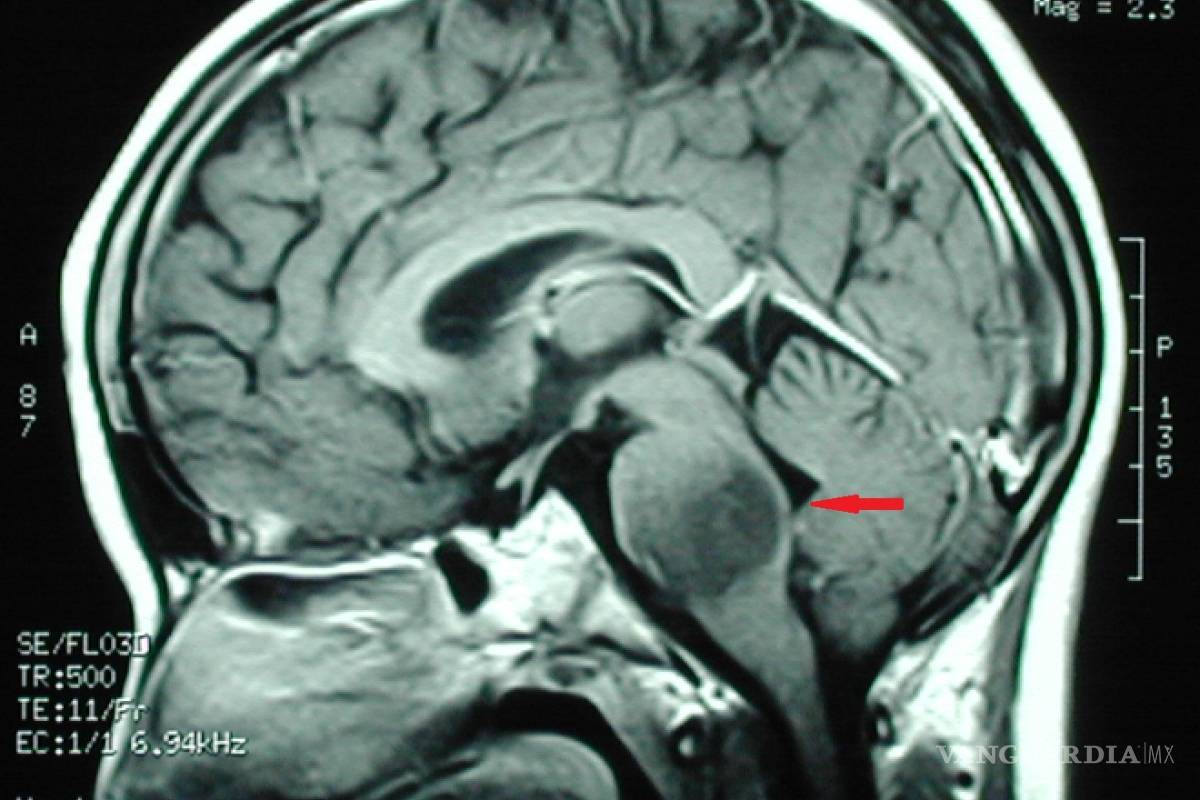 Médico saltillense desarrolla terapia para tratar los tumores cerebrales