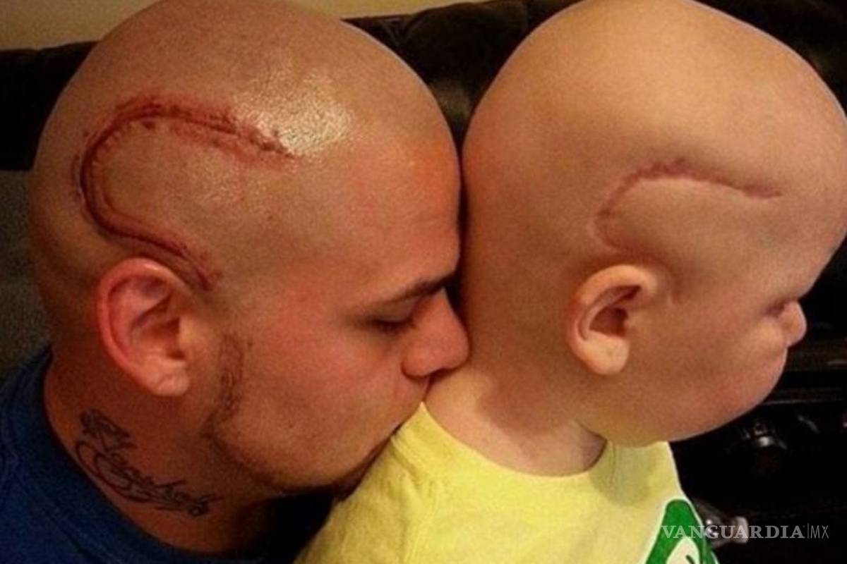 Fallece niño por tumor en el cerebro cuyo padre se tatuó su cicatriz