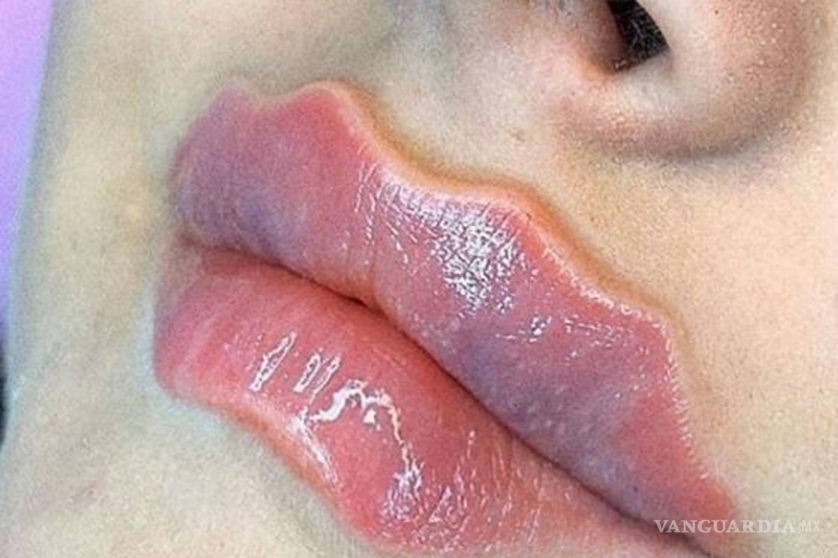Labios del diablo, nueva y peligrosa moda que te puede desfigurar la cara