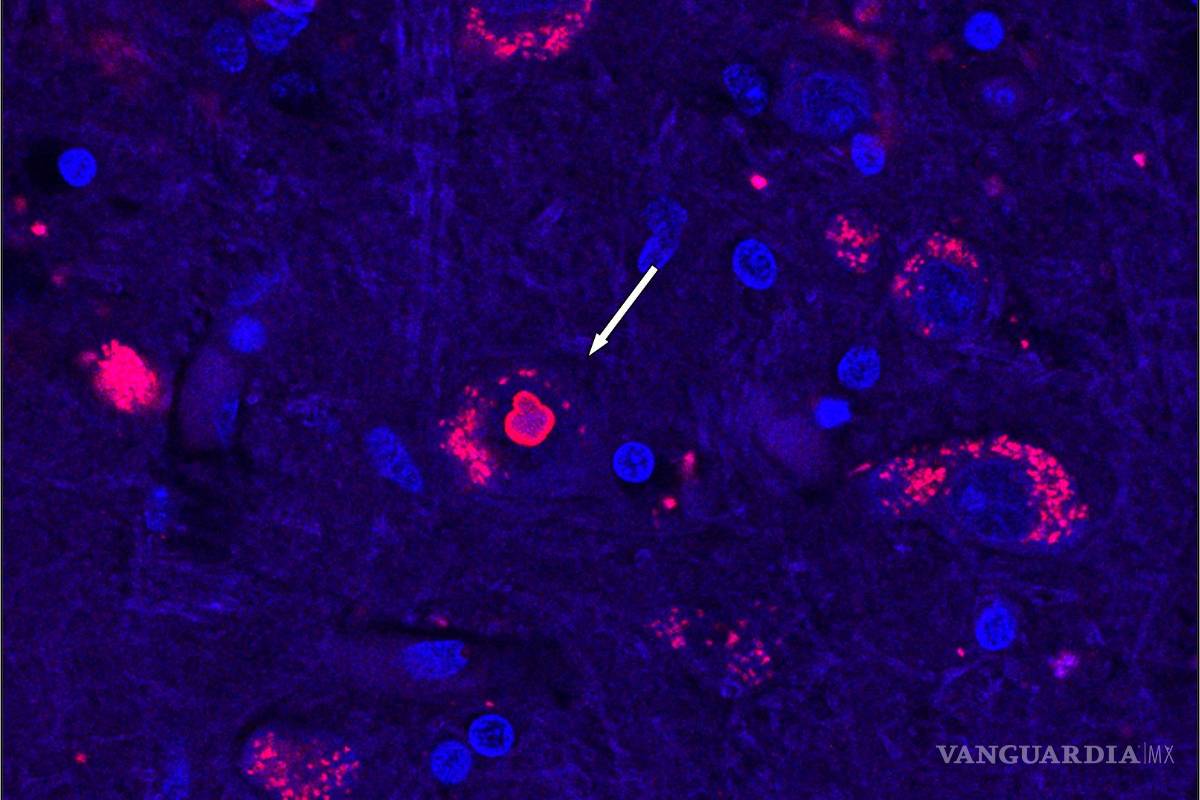 Descubren la causa de la ataxia espinocerebelosa 4, una rara enfermedad genética, con lo que se despeja el camino para futuras terapias
