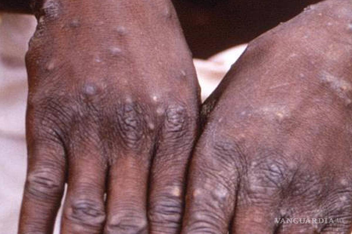 Viruela del mono, mortal para quienes tienen VIH o un sistema inmune débil: estudio