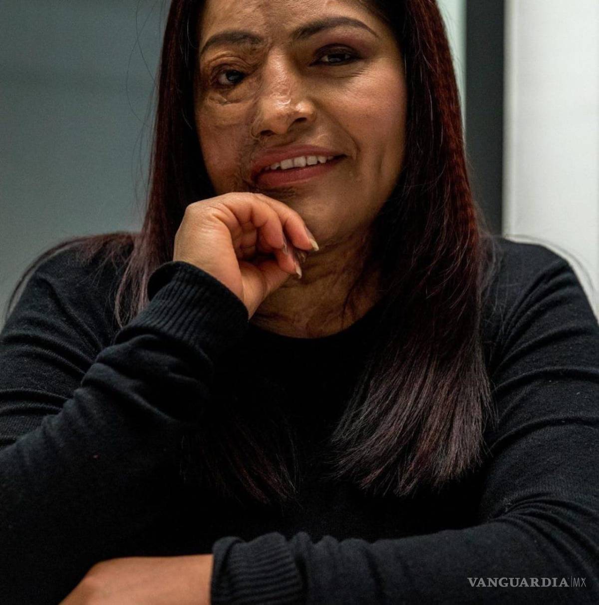 $!Por medio de la organización que lleva su nombre, Carmen Sánchez ha abogado por las mujeres víctimas de ataques con ácido.
