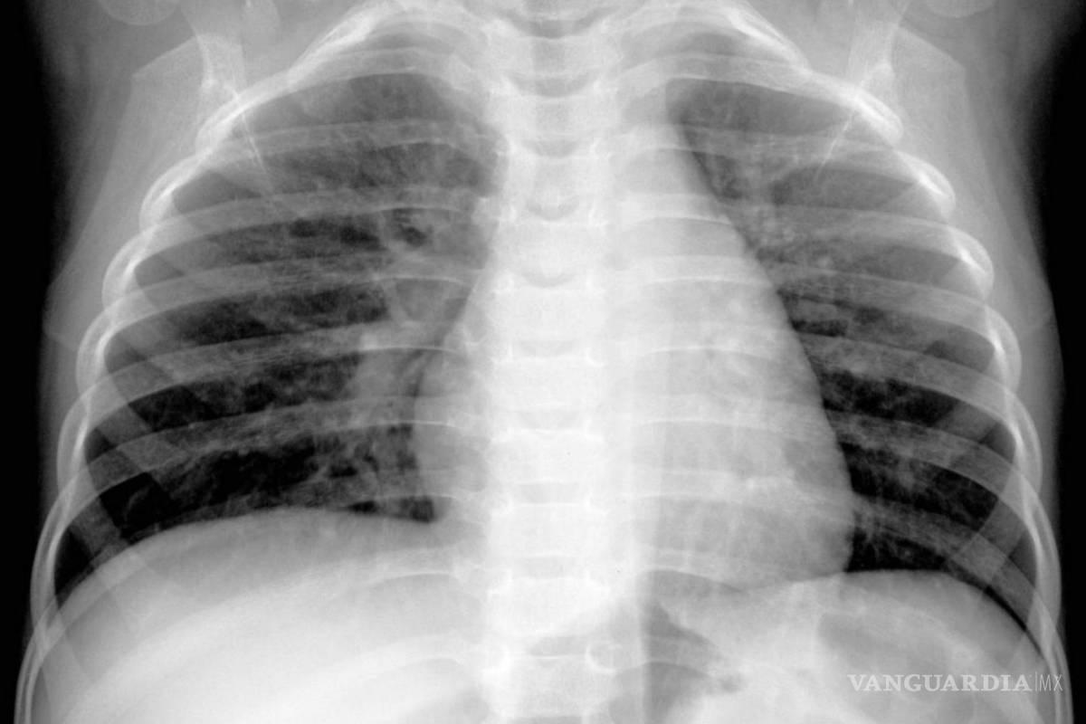 $!Una imagen de rayos X proporcionada por Hilmes et al., Pediatric Radiology, 2017 muestra a un niño de cuatro meses infectado por metapneumovirus humano.