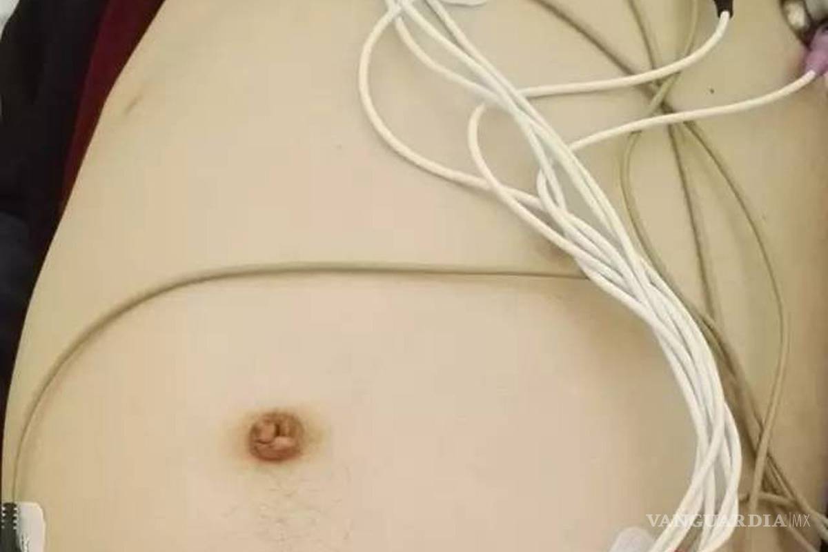 $!Retiran 13 kilos de heces de un hombre estreñido con cirugía