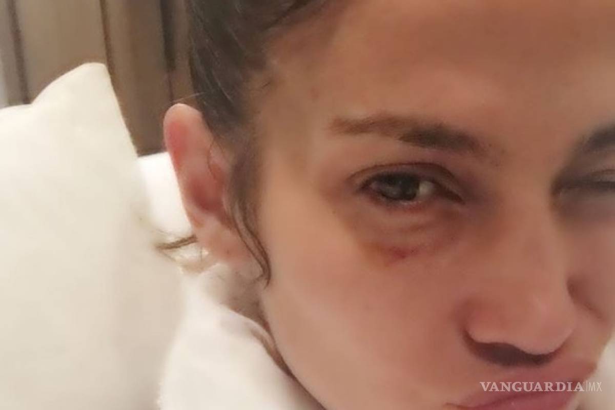Jennifer López publica foto con el ojo morado