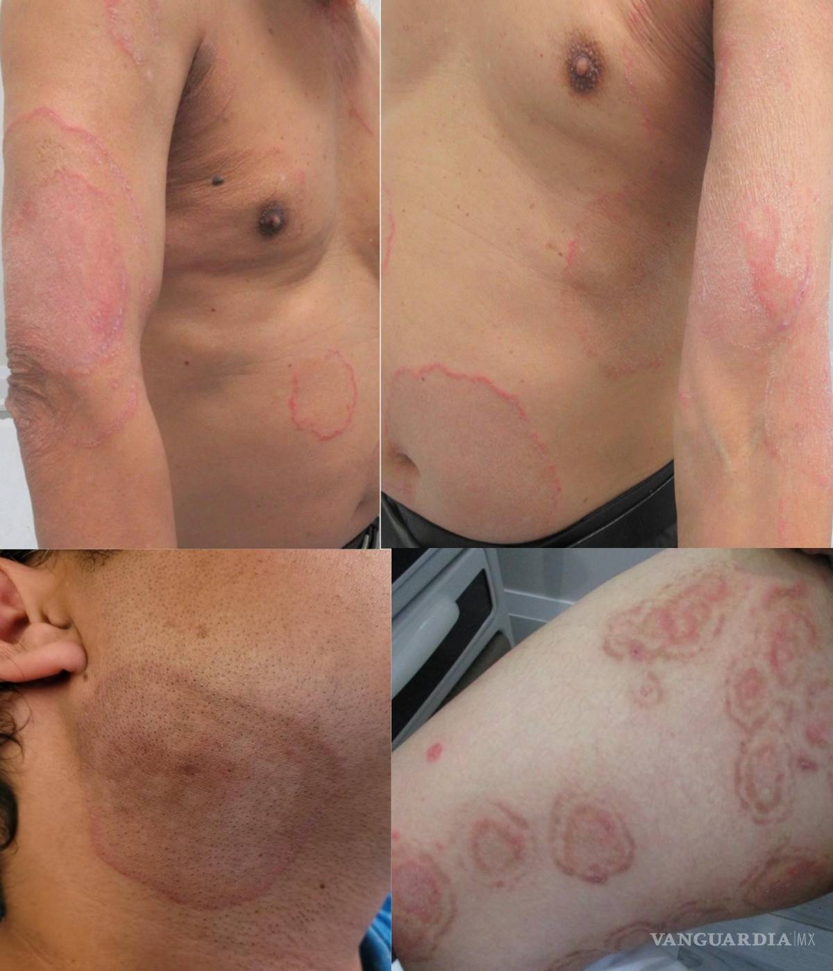 $!La dermatofitosis suele presentar escamas y color rojizo, y puede causa picazón