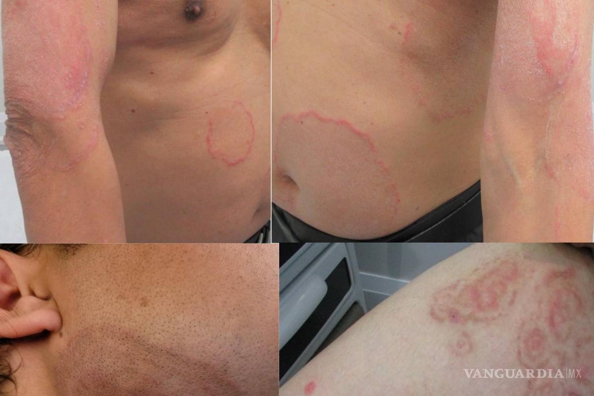 $!La dermatofitosis suele presentar escamas y color rojizo, y puede causa picazón