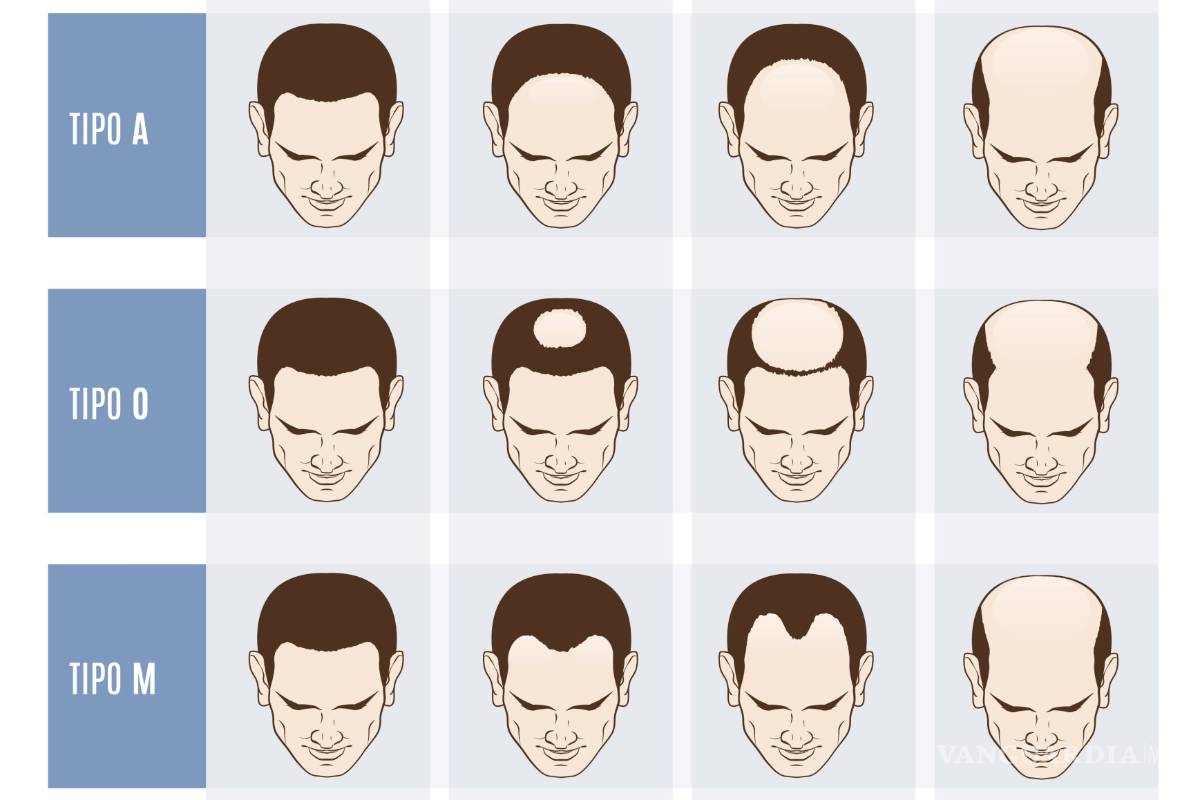 $!Calvicie: el terror en la 'azotea' que nadie quiere experimentar