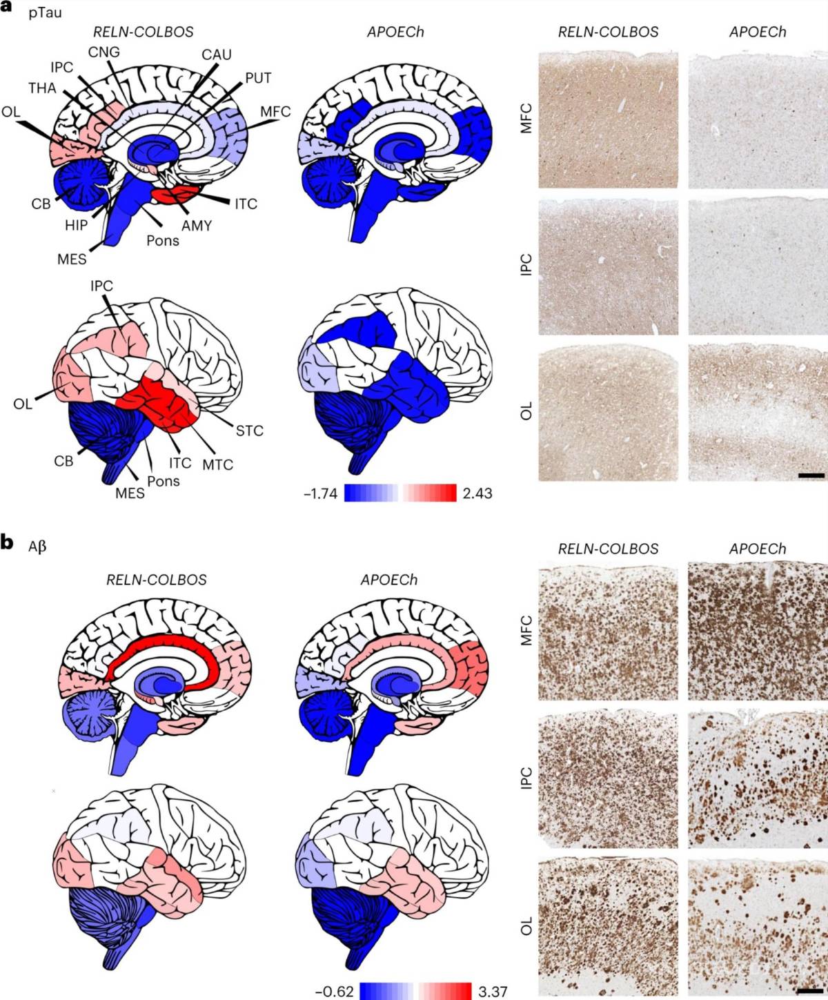 $!Distribución cerebral de las características de la EA en los casos con RELN-COLBOS y APOECh.