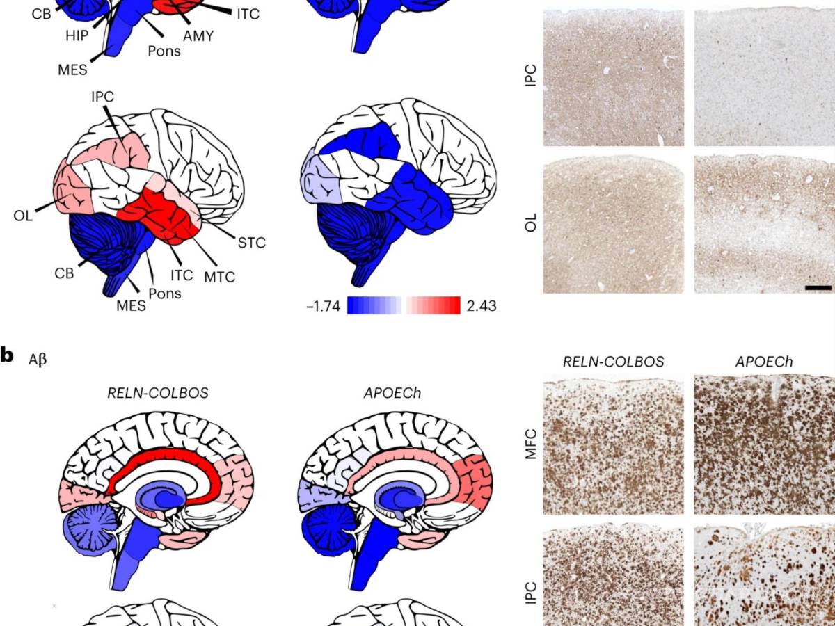 $!Distribución cerebral de las características de la EA en los casos con RELN-COLBOS y APOECh.