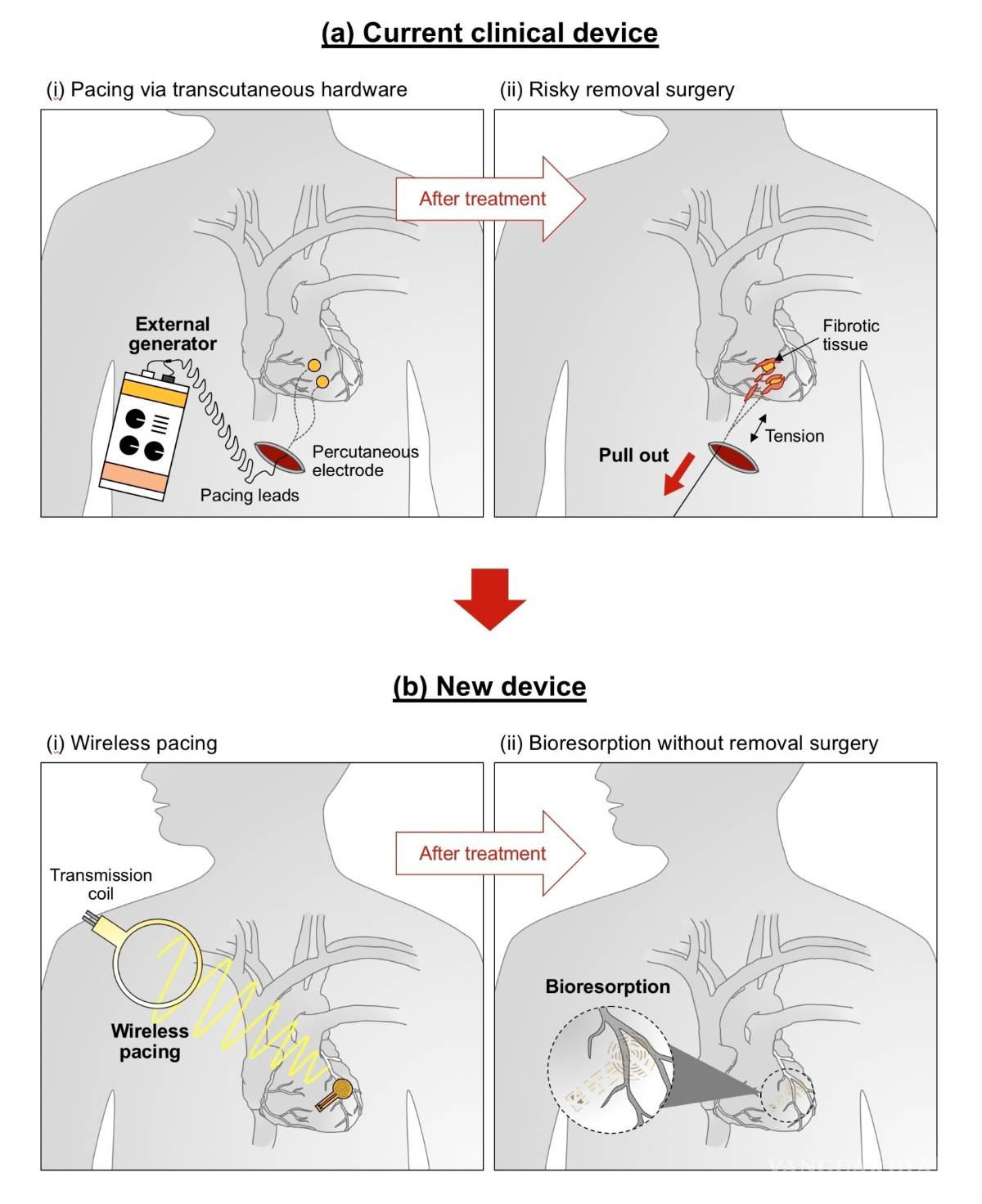 $!Crean en Estados Unidos el primer marcapasos biodegradable