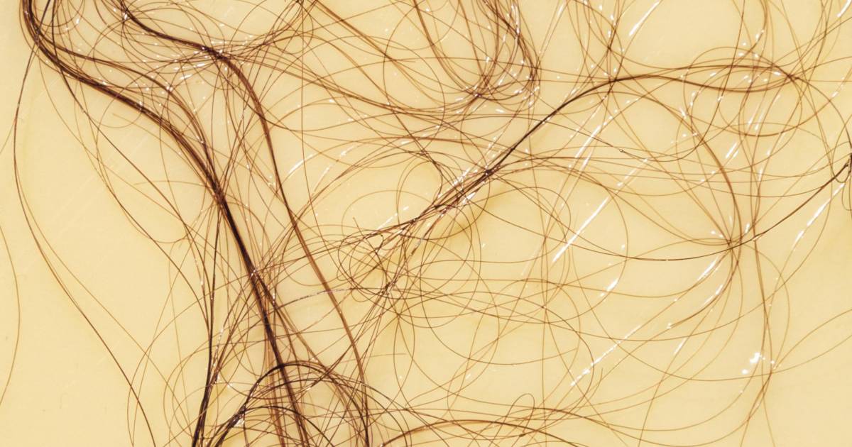 ¿El estrés puede provocar la caída del cabello?