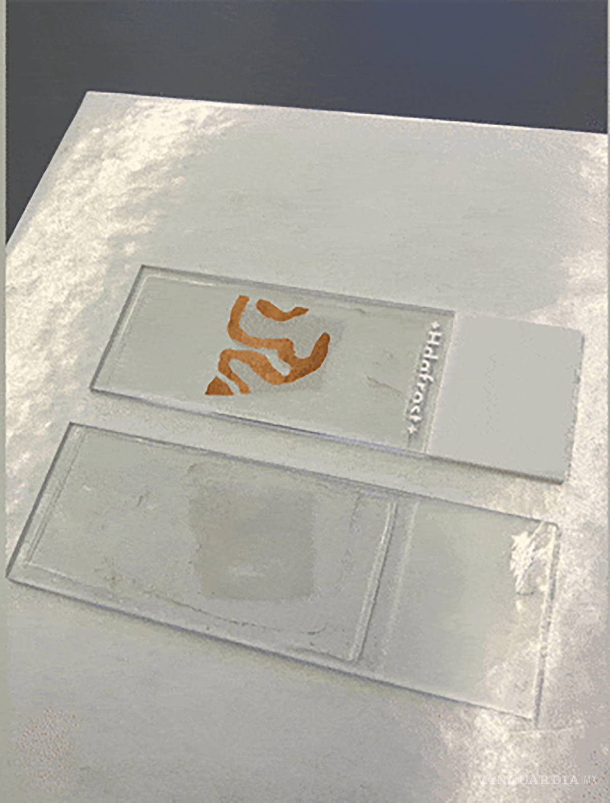 $!En la placa superior se observa (resaltadas informáticamente en color marrón) placas de beta amilode de tejido cerebral con Alzheimer que no recibió tratamiento farmacológico inmunizador.