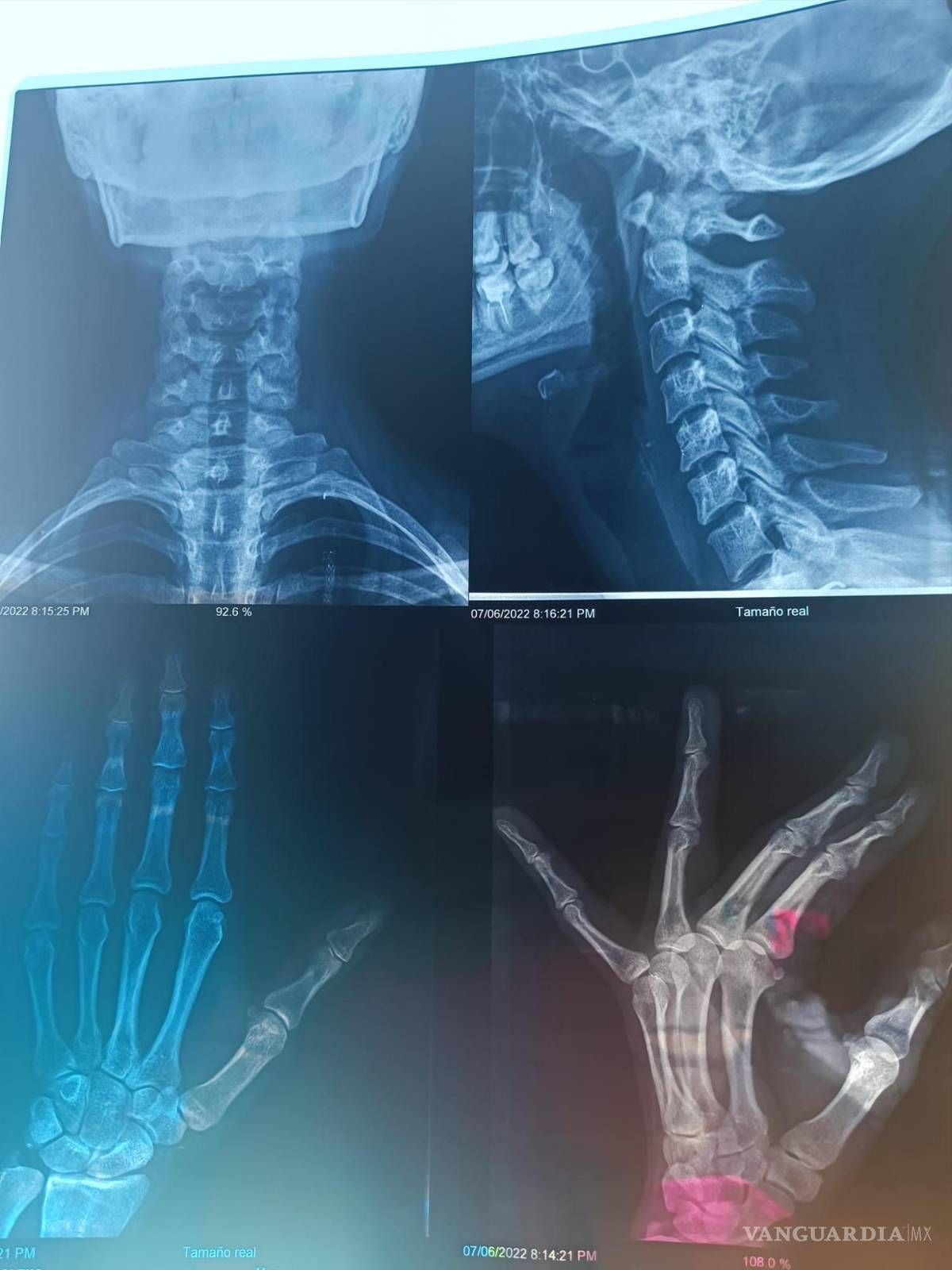 $!Imagenes de las radiografías de Alexa.