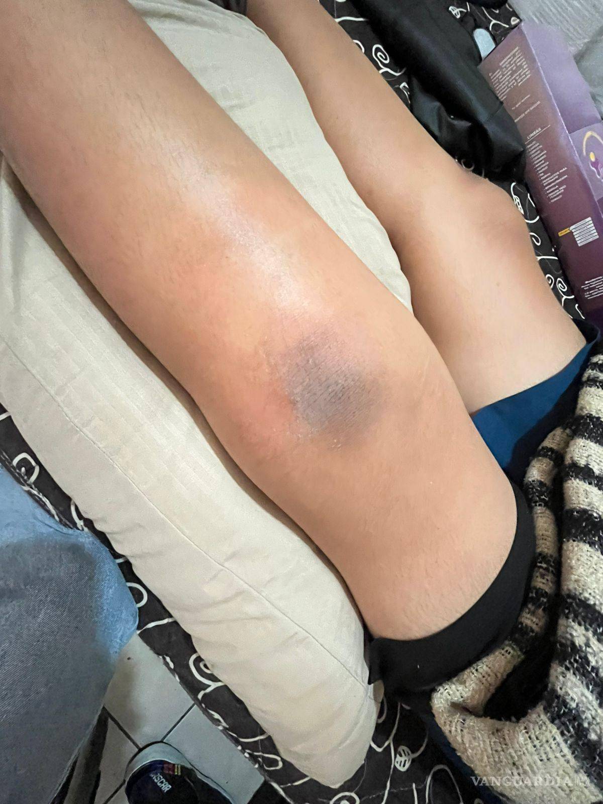 $!La cirugía del estudiante implicó la colocación de tornillos en la tibia, costos que inicialmente cubrieron los tutores.