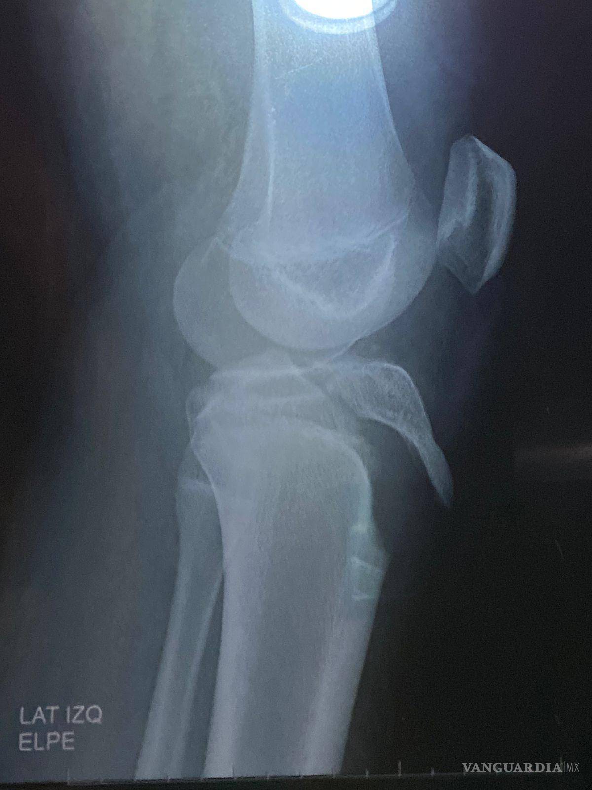 $!Padres denuncian que el colegio no siguió los protocolos de atención médica ni llamó a una ambulancia tras la lesión.