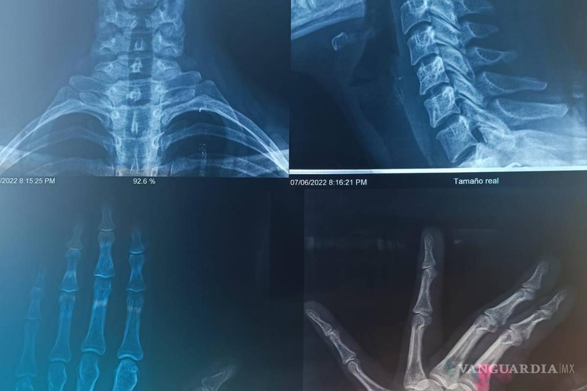 $!Imagenes de las radiografías de Alexa.