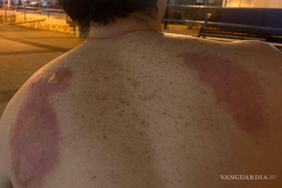 $!Algunos de los asistentes terminaron con quemaduras graves.