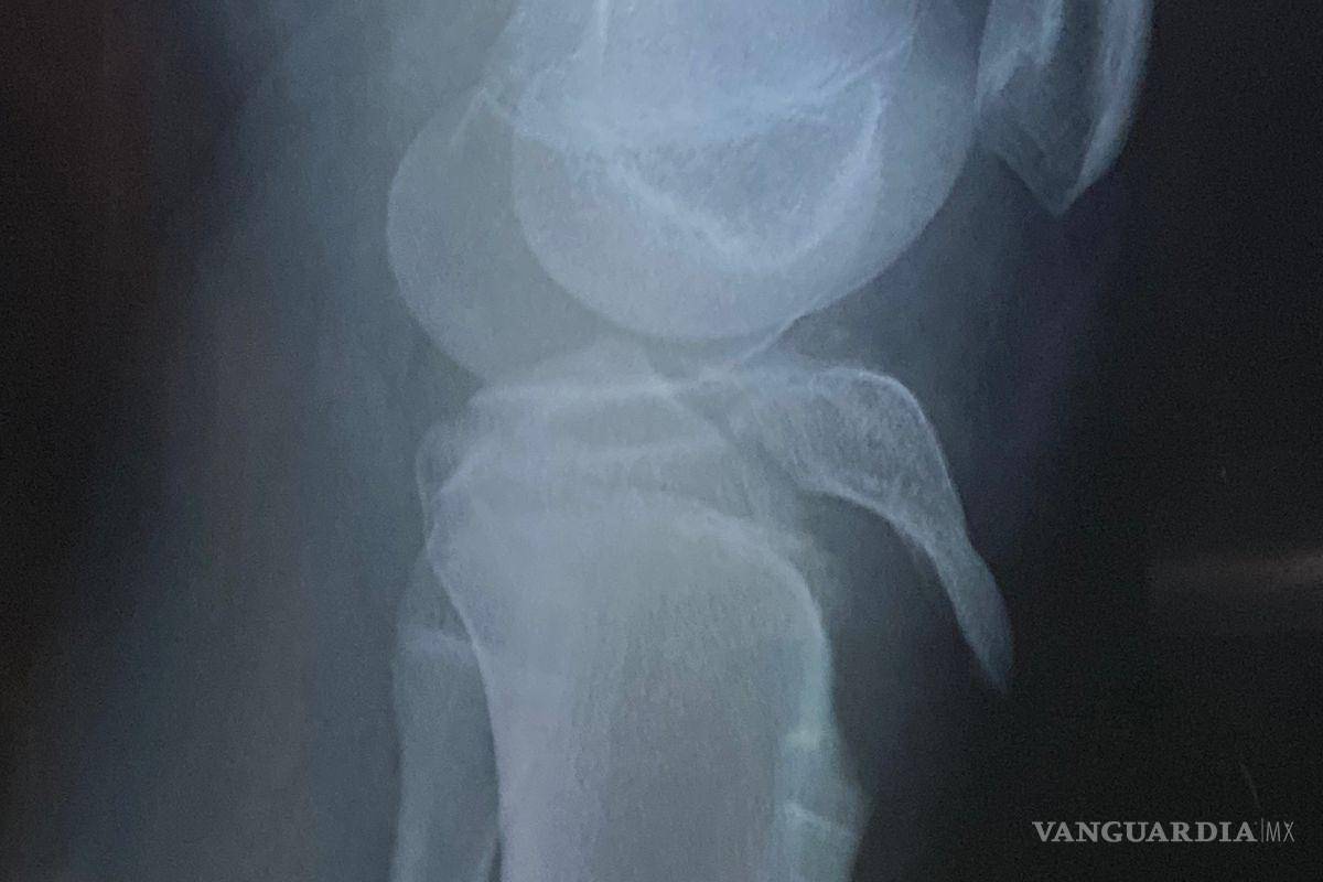 $!Padres denuncian que el colegio no siguió los protocolos de atención médica ni llamó a una ambulancia tras la lesión.