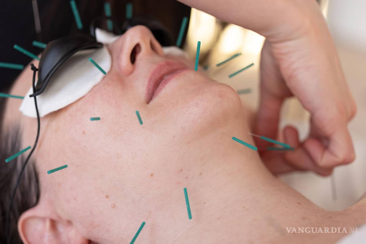 ¿Puede la acupuntura estética ser el nuevo bótox?