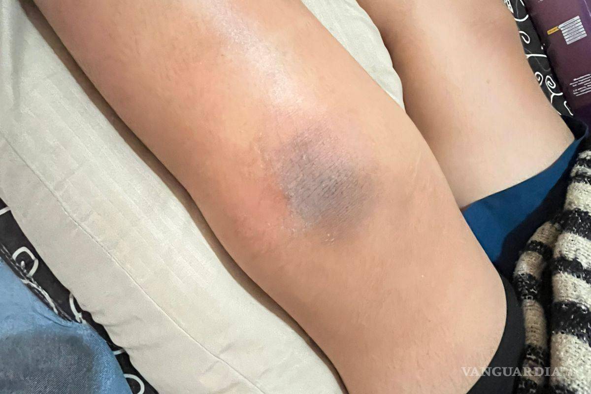 $!La cirugía del estudiante implicó la colocación de tornillos en la tibia, costos que inicialmente cubrieron los tutores.