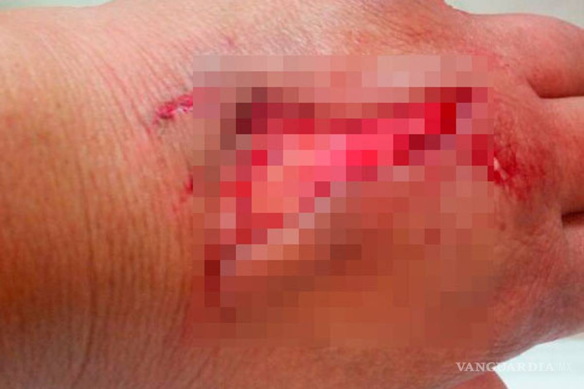 En Parras, mujer sufre ataque de perro pitbull