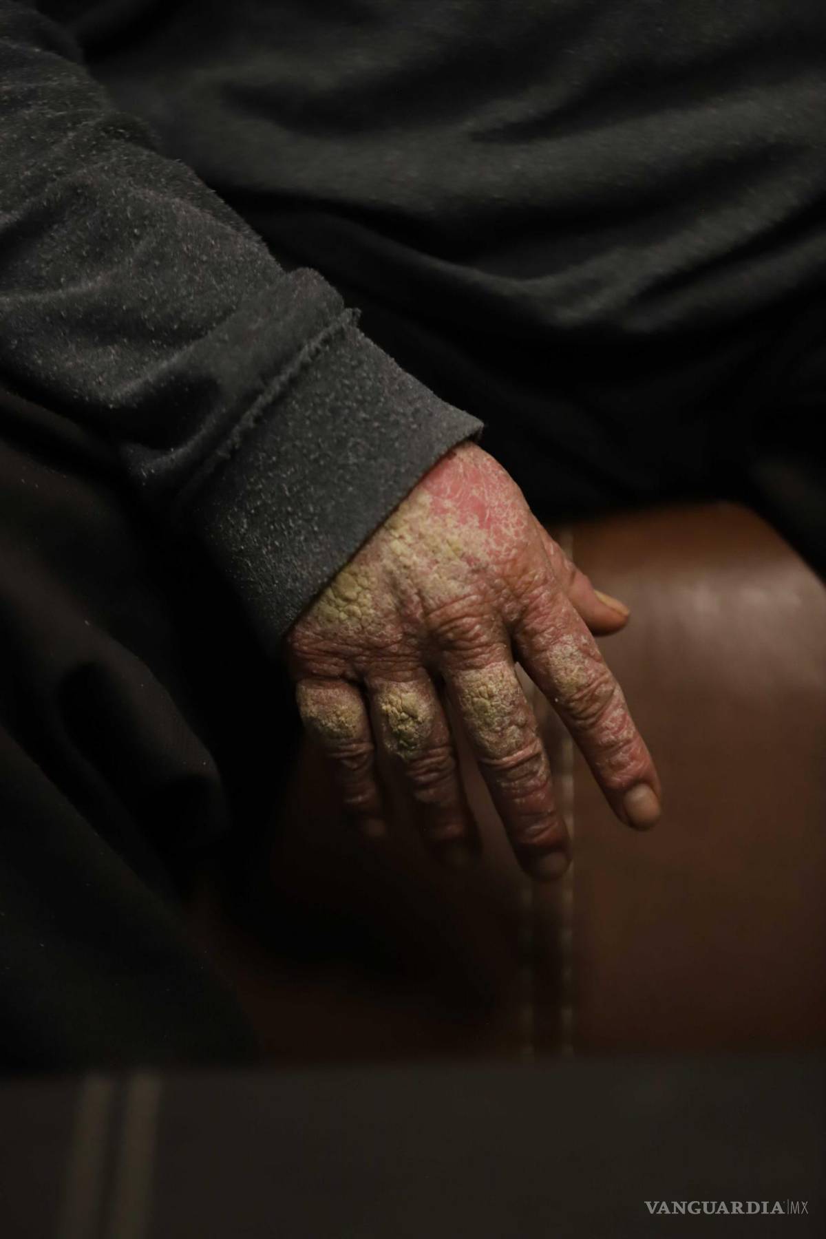 $!La psoriasis artrítica de Regino le provoca llagas y malformaciones óseas, haciendo que cada día sea un desafío debido al dolor constante.