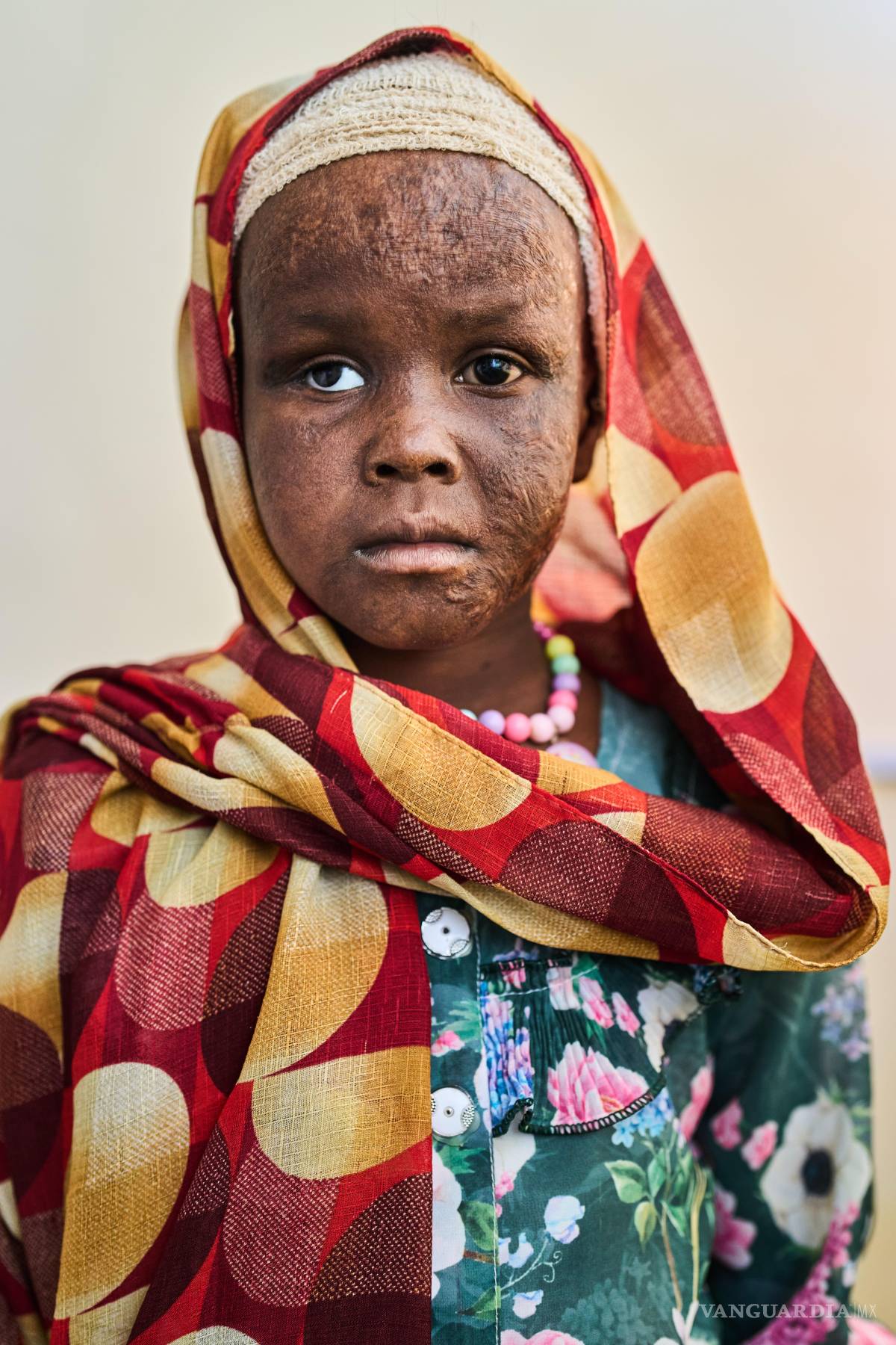 $!Zeinab Mujhed, de 8 años, herida en un ataque de artillería, posa para una foto en el hospital Al Nao en Omdurman, Sudán, el sábado 18 de abril de 2026.