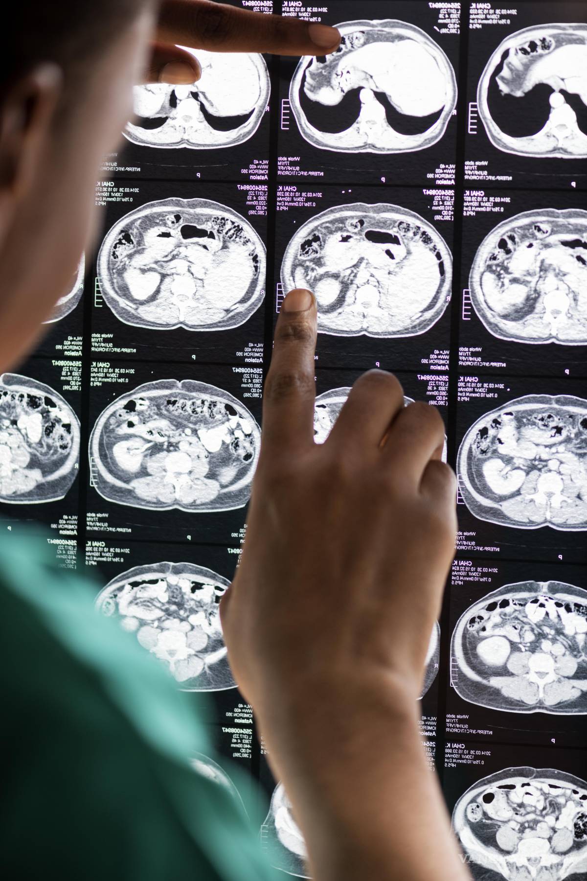 $!Existen dos tipos principales de ictus: el ictus isquémico, al que corresponden casi el 80% de los casos.