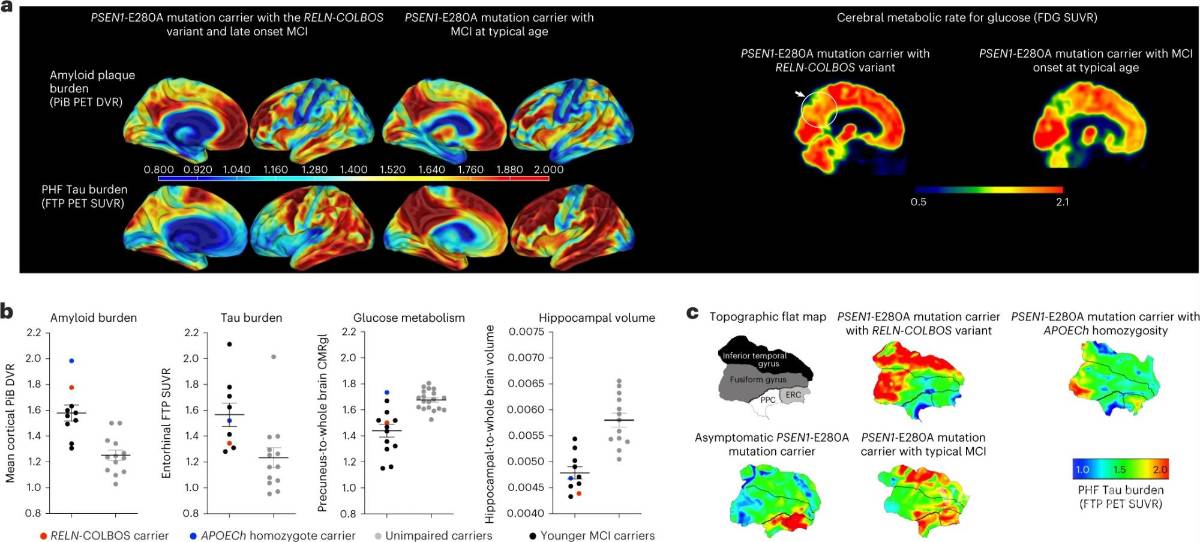 $!Grafica 1: Imagen del PET del portador del gen RELN-COLBOS (H3447R).