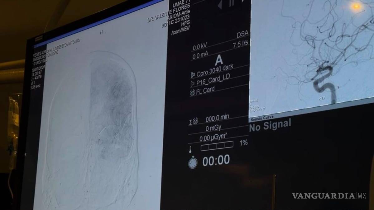 $!La UMAE No. 71 de Torreón ha realizado 241 procedimientos para atender enfermedades vasculares cerebrales durante el último año.