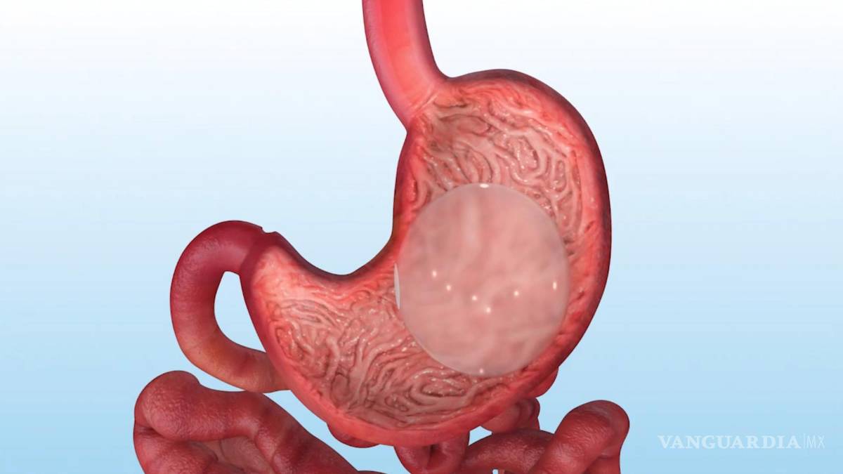$!Imagen representativa del primer balón intragástrico de 1999.