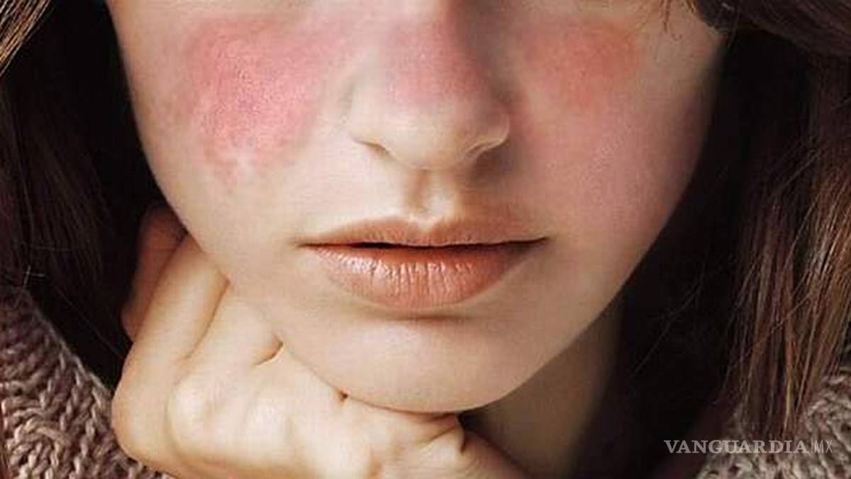 ¿Qué es el lupus?