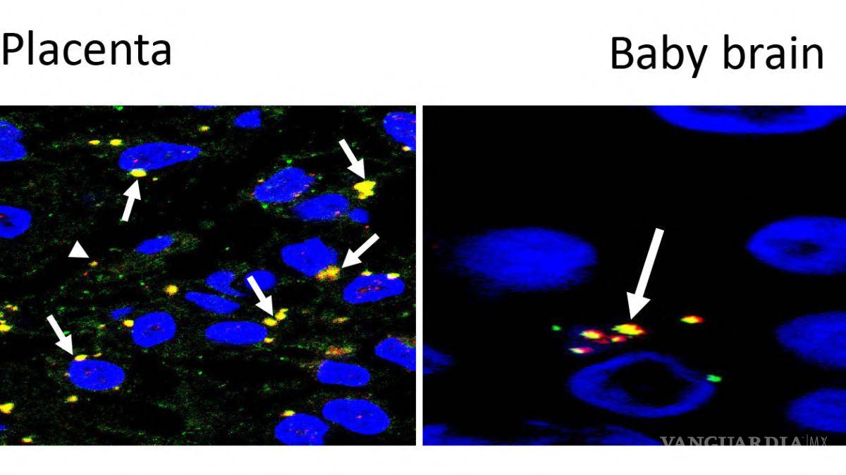 $!Un nuevo estudio mostró que el virus COVID-19 atravesó la placenta y estuvo presente en el cerebro de un recién nacido, provocando una lesión cerebral.