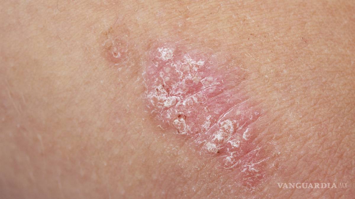 Psoriasis afecta a más de 123 millones de personas
