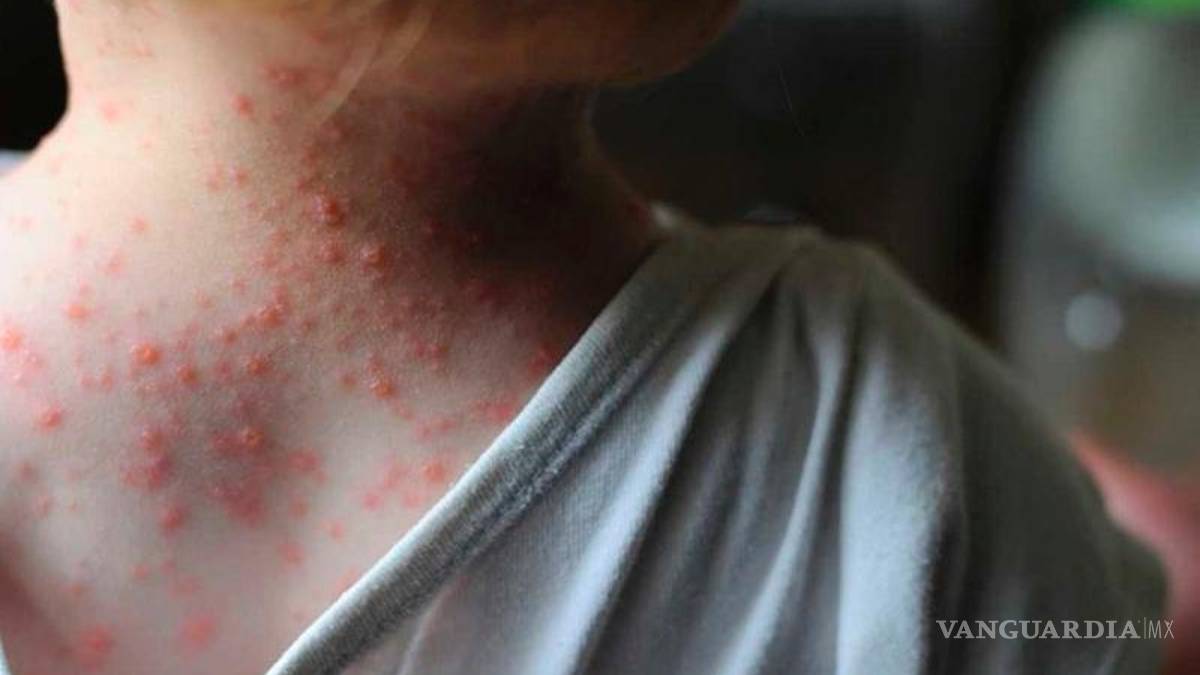 Ve OMS inusual brote de viruela del mono