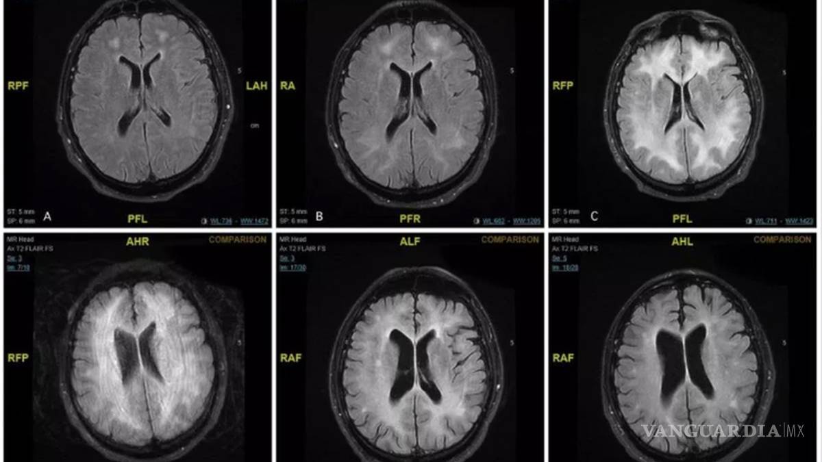 Éste es el daño que la cocaína podría causarle a tu cerebro
